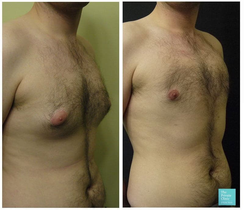 best affordable gynecomastia surgery quotes london