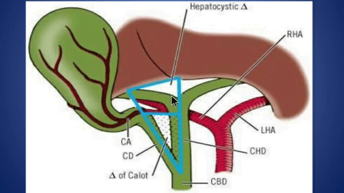 best cholecystectomy pimp questions
