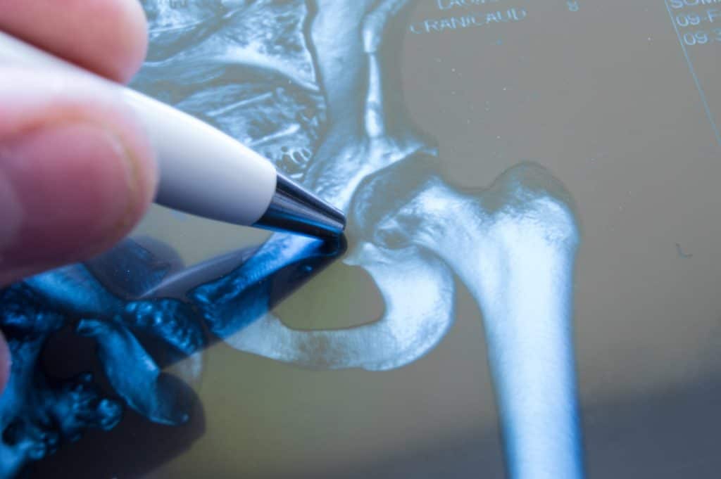best hip replacement questions