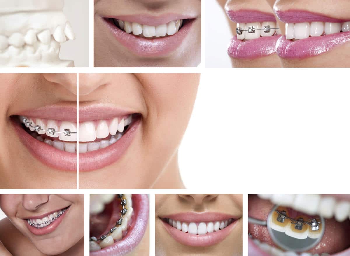 best invisalign frequently asked questions