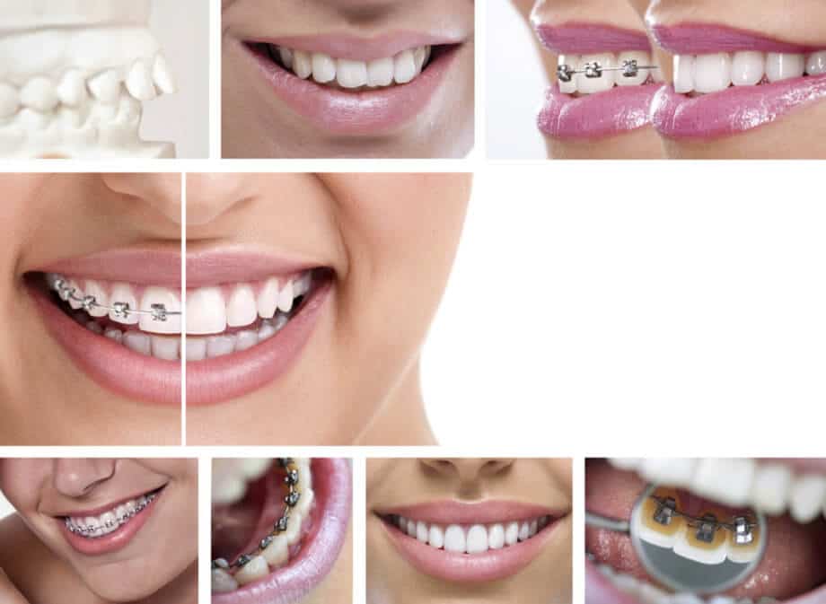 best invisalign questions