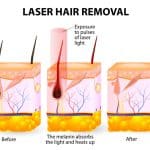 best laser hair removal questions