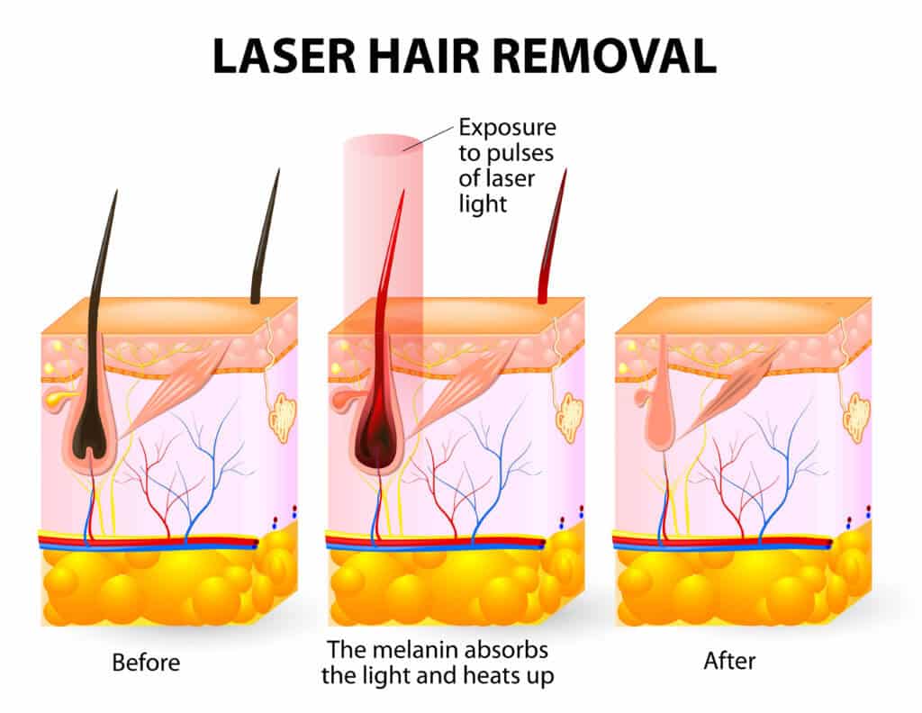 best laser hair removal questions