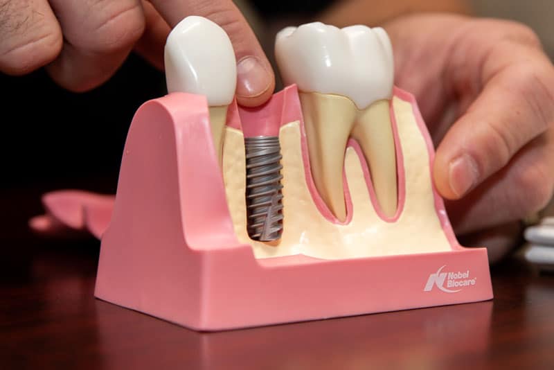 best questions about dental implants