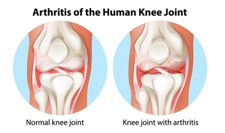 best questions about knee replacement