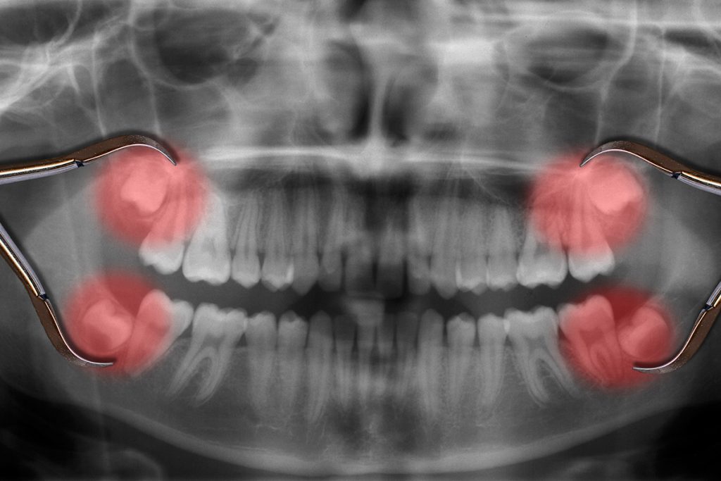 best questions for after wisdom teeth removal