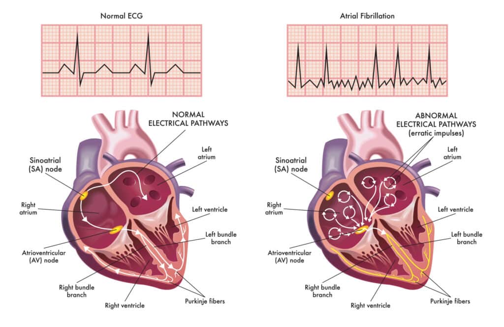 best questions for cardiologist about afib