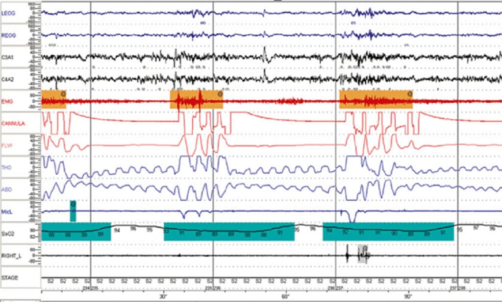 best sleep apnea test results questions